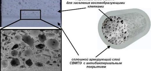 сверхвысокомолекулярный полиэтиленовый имплантполиэтилен